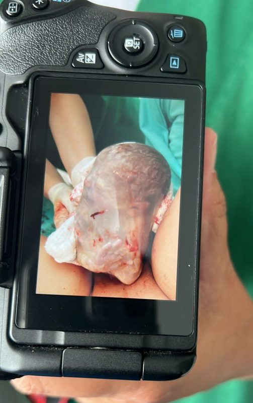 O beb&ecirc; Arthur nasceu empelicado e chamou aten&ccedil;&atilde;o em Chapec&oacute;. &mdash; Foto: Unimed Chapec&oacute;/Reprodu&ccedil;&atilde;o/ND