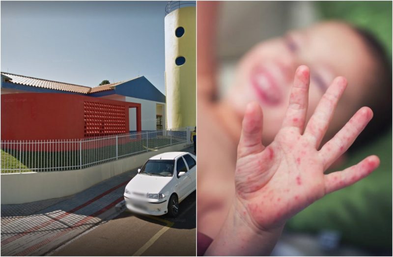 Fotomontagem mostra escola e criança com a mão marcada por sarna humana