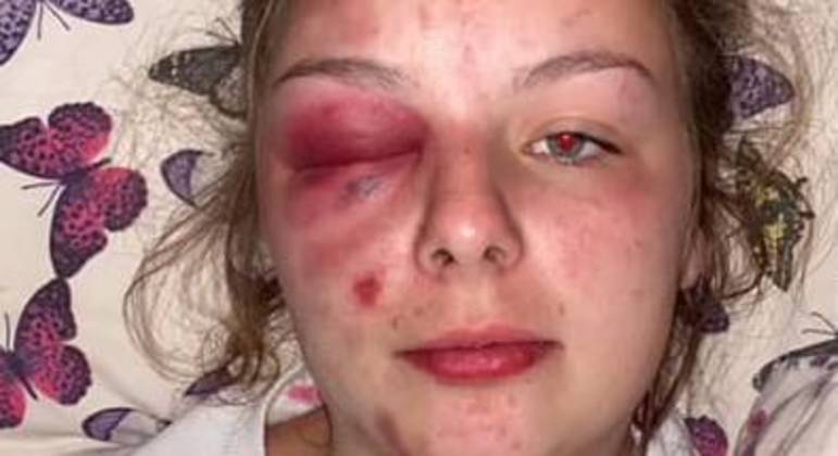 Jovem chegou a desfigurar o pr&oacute;prio rosto com martelo – Foto: Reprodu&ccedil;&atilde;o/Internet