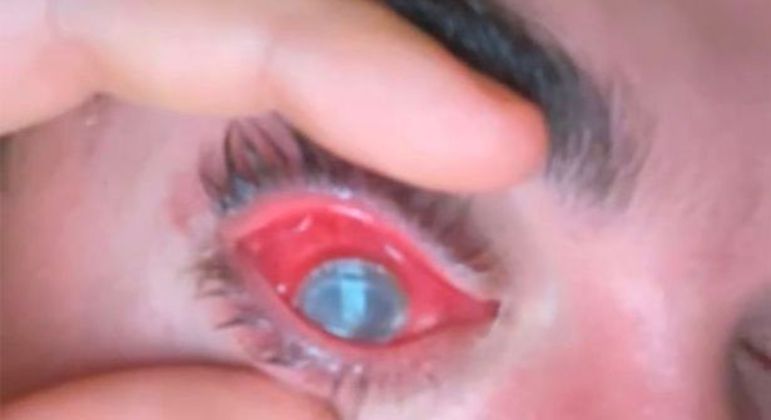 Jovem sofreu infec&ccedil;&atilde;o grave ap&oacute;s dormir com lentes de contato – Foto: Daily Star/Reprodu&ccedil;&atilde;o/ND