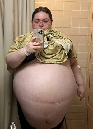 O tumor tinha o tamanho de 50 cmX 50 cm – Foto: Ascension St. Vincent&rsquo;s Jacksonville