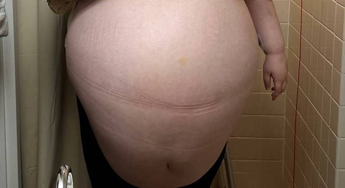 jovem grávida tumor grande