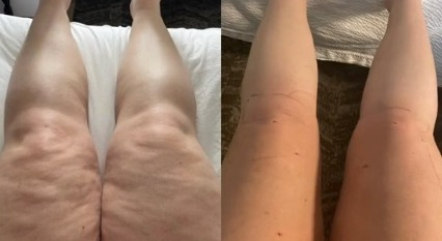 Antes e depois das pernas de Alisa ap&oacute;s a primeira cirurgia – Foto: alisamariev/TikTok/Reprodu&ccedil;&atilde;o/ND