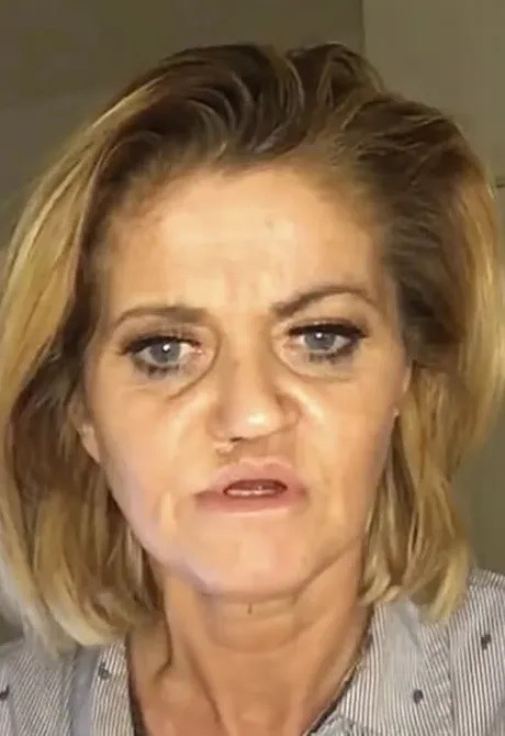 Rosto da atriz Danniella Westbrook ficou desfigurado – Foto: Reprodu&ccedil;&atilde;o/Instagram