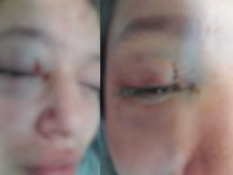 Aluna teve ferimentos no rosto e ficou temporariamente sem vis&atilde;o – Foto: Arquivo Pessoal/ND