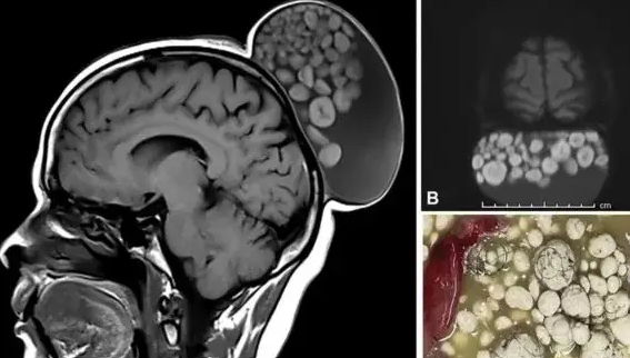 Exame m&eacute;dico revela semelhan&ccedil;a de caro&ccedil;o, a um saco de bolinhas de gude. – Foto: Divulga&ccedil;&atilde;o/Radiology