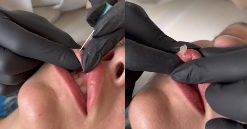 Preenchimento labial pode ser removido 