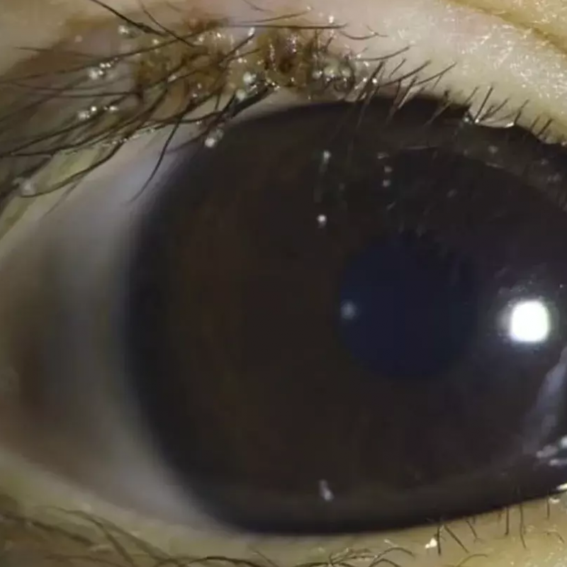 Piolhos foram encontrados nos cílios de uma criança de 3 anos