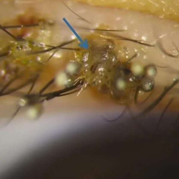 Piolhos foram encontrados nos cílios de uma criança de 3 anos