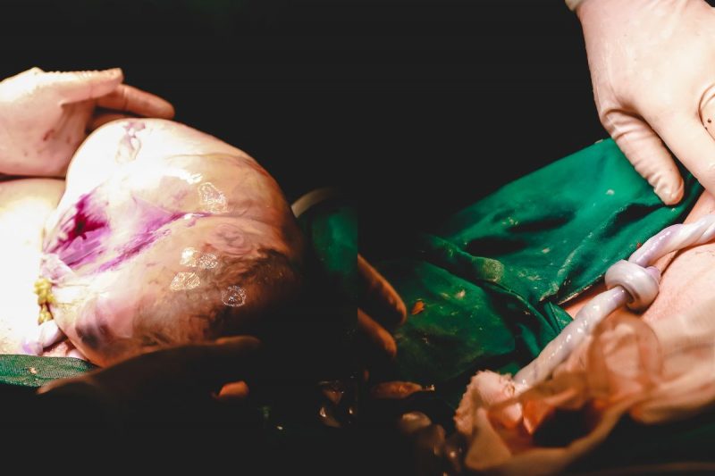 Bebês surpreenderam em parto raro