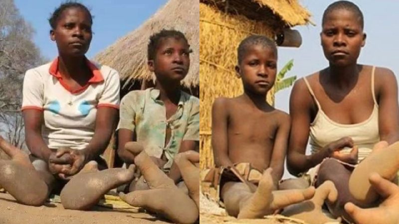 Tribo apresenta deformidade gen&eacute;tica nos p&eacute;s – Foto: Reprodu&ccedil;&atilde;o/Gana Web/ND