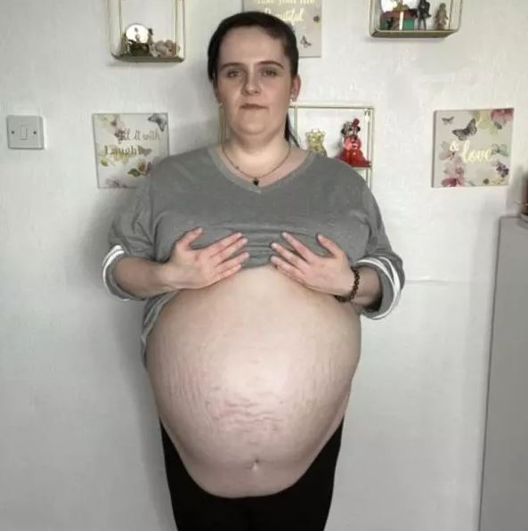 A mulher esperou por mais de 11 meses para a cirurgia de retirada do cisto gigante