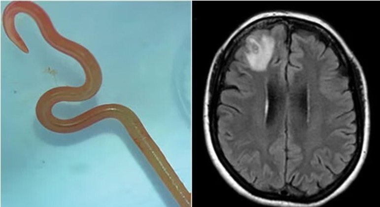 An 8 cm long worm was found in the patient's brain. Photo: Canberra Health/Reproduction/ND