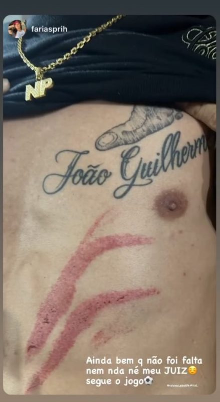 Marca deixa no abdômen de Natanael após a entrada de Rodrigo no jogo entre Avaí e Criciúma