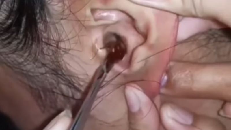 The animal hid in the woman's ear and was removed - Photo: Biologisa Henrique/Reproduction/ND