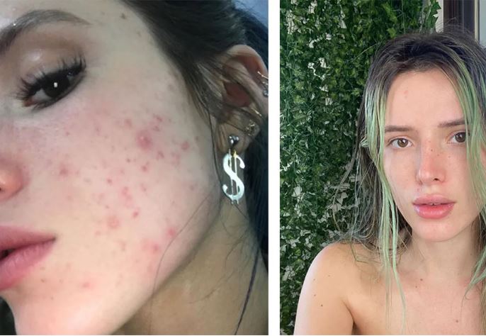 adult acne