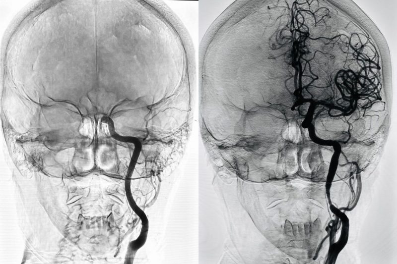 Recurso milionário ajudará pacientes com AVC