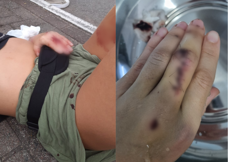 Moradora fratura a m&atilde;o ap&oacute;s acidente com patinete – Foto: Arquivo Pessoal/ND