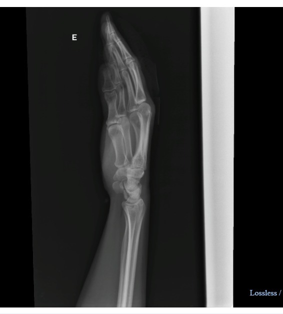 Flora fraturou o dedo e precisou levar 10 pontos – Foto: Arquivo Pessoal/ND