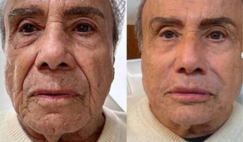 Especialista em harmoniza&ccedil;&atilde;o facial &eacute; outra profiss&atilde;o em alta em 2024. O ator Stenio Garcia aderiu ao procedimento aos 91 anos de idade&nbsp; – Foto: Reprodu&ccedil;&atilde;o/Instagram