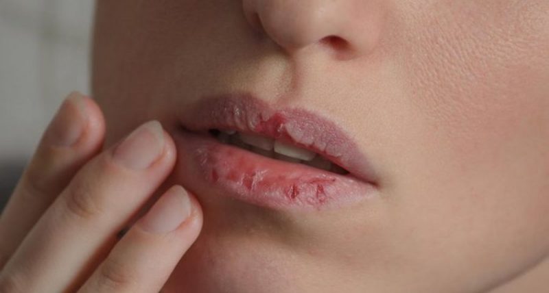 Feridas na boca que aumentam ou não cicatrizam podem ser sinais de câncer de lábio