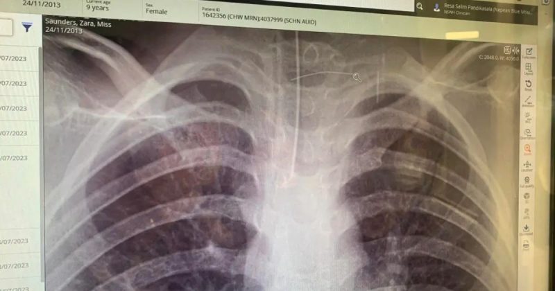 Menina teve uma grave infecção