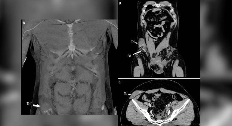Tomografia mostra test&iacute;culo alojado no abd&ocirc;men do paciente – Foto: Reprodu&ccedil;&atilde;o/ND