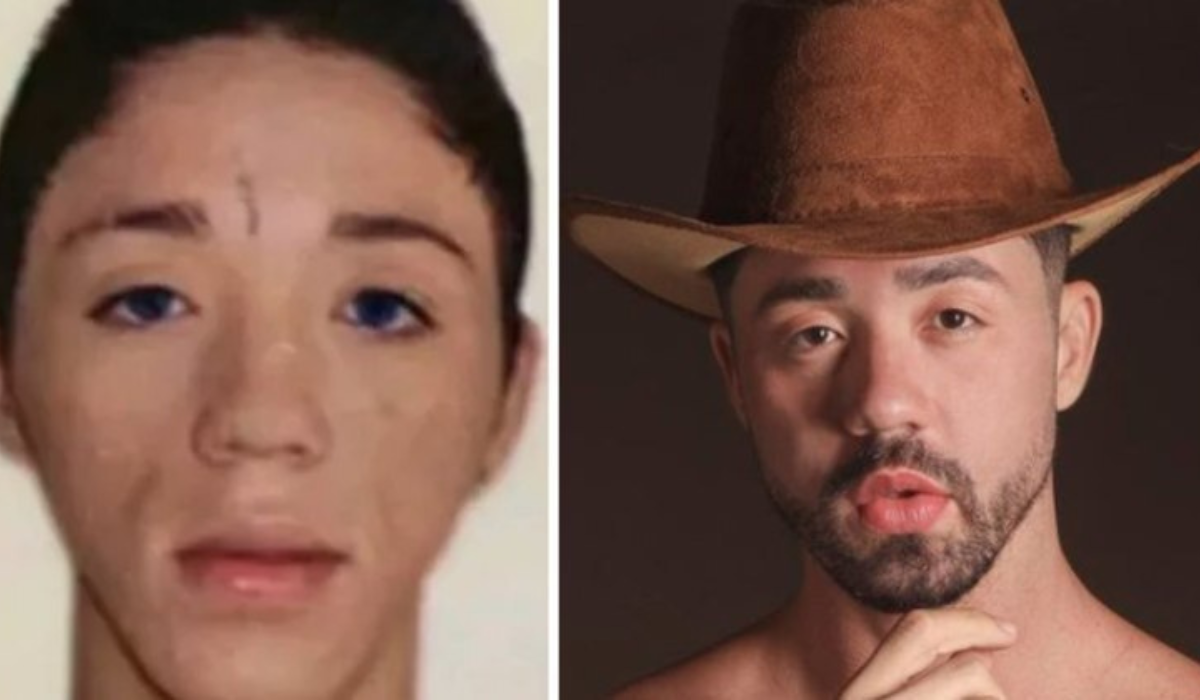 Influencer Bruno Diferente faz harmonização facial e surpreende