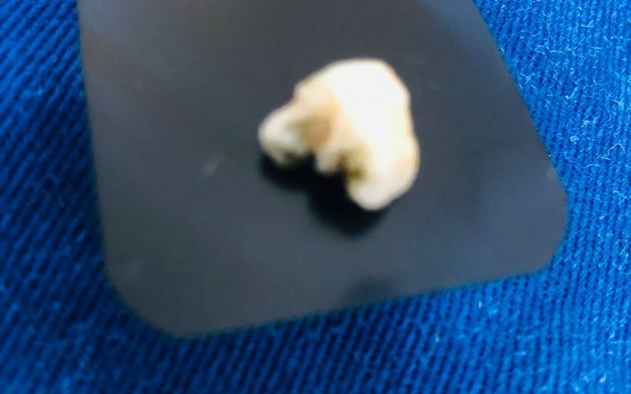 Imagem mostra dente não humano que encontrou em marmita servida para a secretaria de saúde