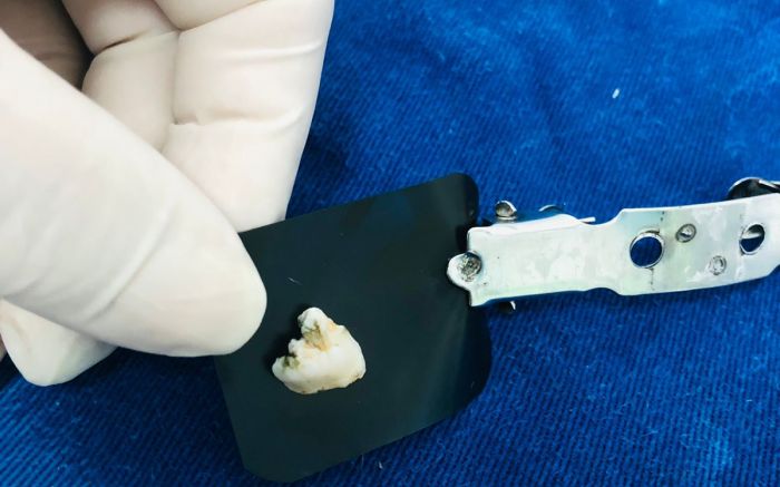 Dente encontrado por servidora foi analisado por dentista, como mostra imagem