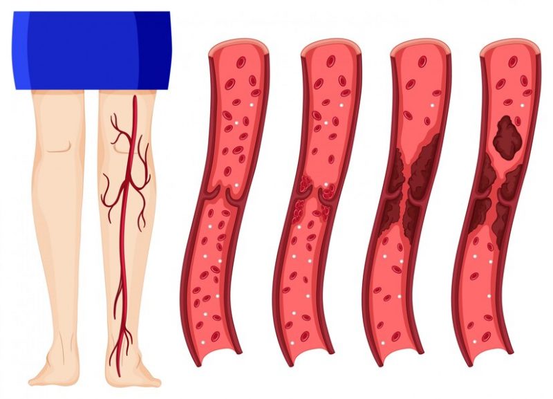 Illustration of leg veins affected by thrombosis