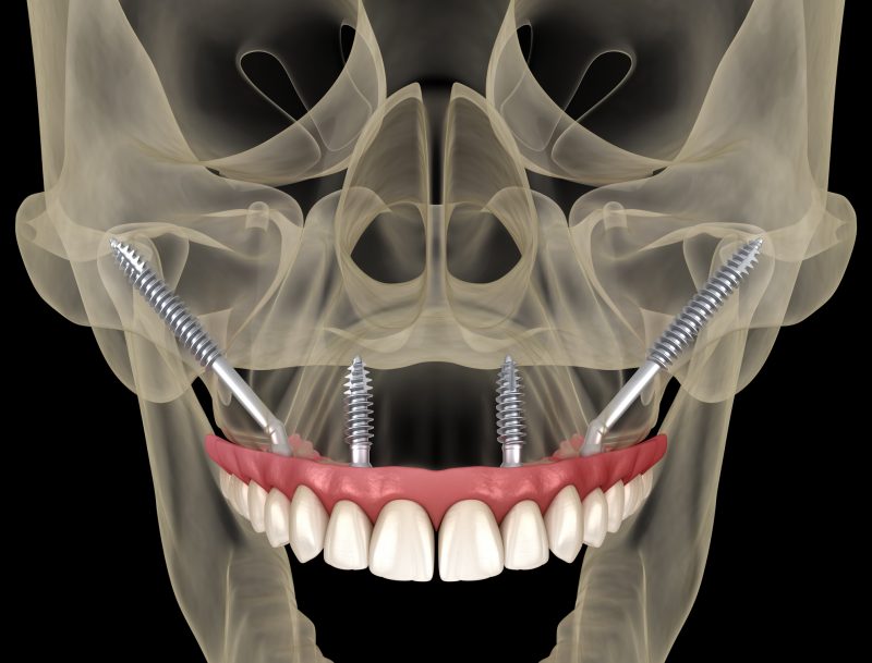 Zygomatic implant, a procedure indicated for oral rehabilitation.