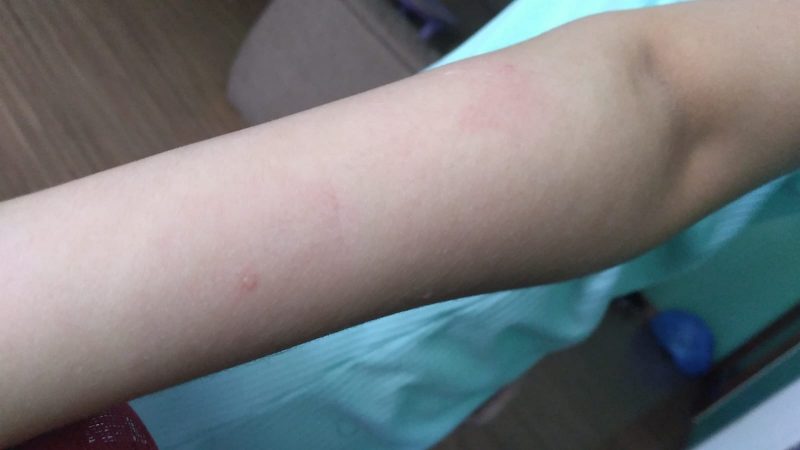 Criança de 9 anos é picada por abelha no Parque de Coqueiros e mãe faz alerta