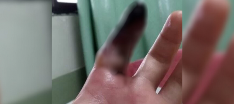 Homem é picado por aranha-marrom e faz vakinha online para tratamento