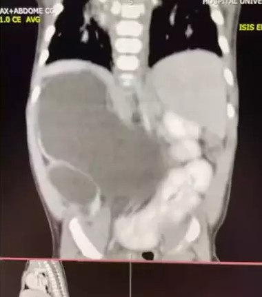 Beb&ecirc; nasceu com anomalia rara e que foi registrada apenas 100 vezes no mundo todo – Foto: Arquivo Pessoal: Thalia Silva Alves/Reprodu&ccedil;&atilde;o/ND