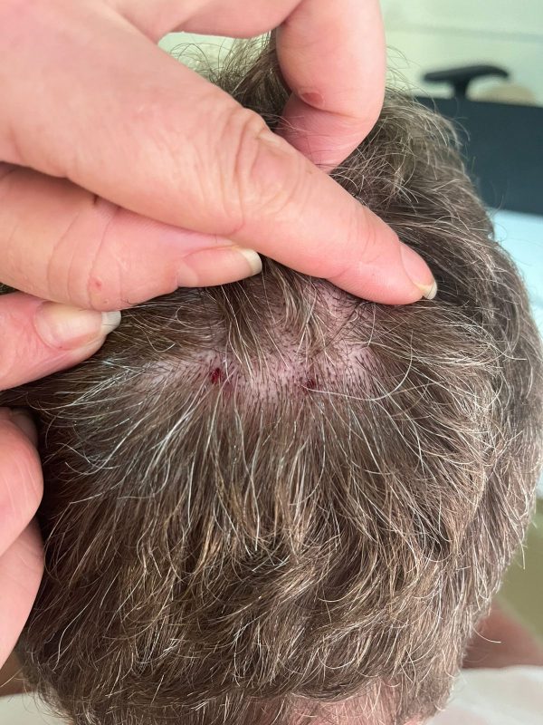 Morador de Api&uacute;na foi picado por uma cobra na cabe&ccedil;a – Foto: Divulga&ccedil;&atilde;o/Reprodu&ccedil;&atilde;o/ND