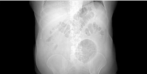 O que é divertículo gigante, doença raríssima descoberta no RJ com apenas 200 casos no mundo?