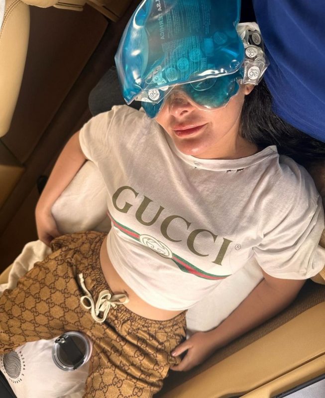 Tomografia confirmou uma fratura no nariz e a cantora foi submetida &agrave; cirurgia – Foto: Reprodu&ccedil;&atilde;o Instagram/ND