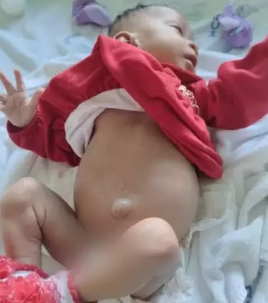 Pequena &Iacute;sis j&aacute; precisou passar por diversas interna&ccedil;&otilde;es e um dos rins da menina foi retirado – Foto: Arquivo Pessoal: /Reprodu&ccedil;&atilde;o/ND