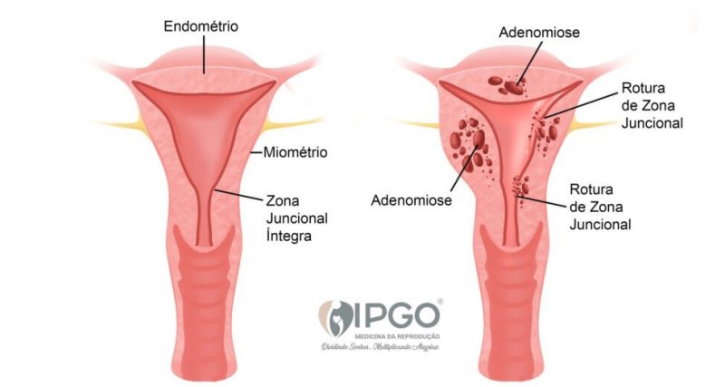 A adenomiose é o crescimento anormal do tecido endometrial dentro da parede muscular do útero. 