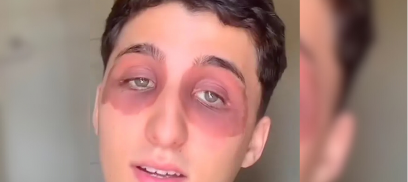 Mordida de barata ou dermatite? Jovem levanta discussão 