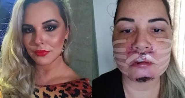 Lábio superior de influenciadora fica deformado após procedimento