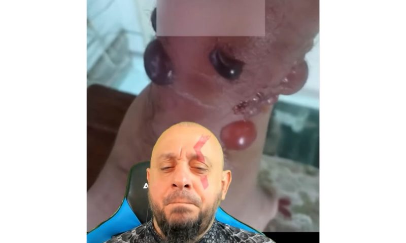 Picada deixou a perna da v&iacute;tima com estranhas forma&ccedil;&otilde;es – Foto: Reprodu&ccedil;&atilde;o