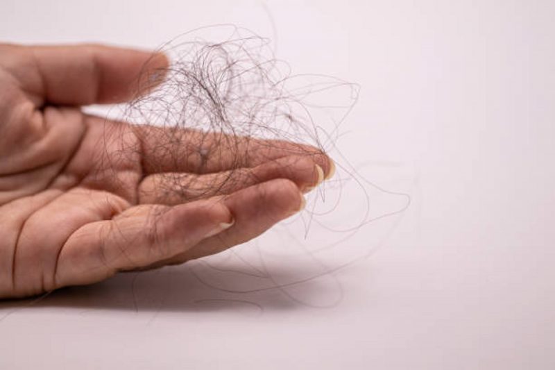 Queda de cabelo pode atingir tanto homens quanto mulheres, segundo dermatologista Marcela Rodrigues - Foto: Reprodução