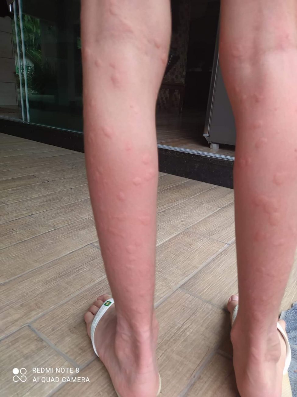 Alergia causada por picada de mosquito – Jaqueline Fischer/Reprodução ND