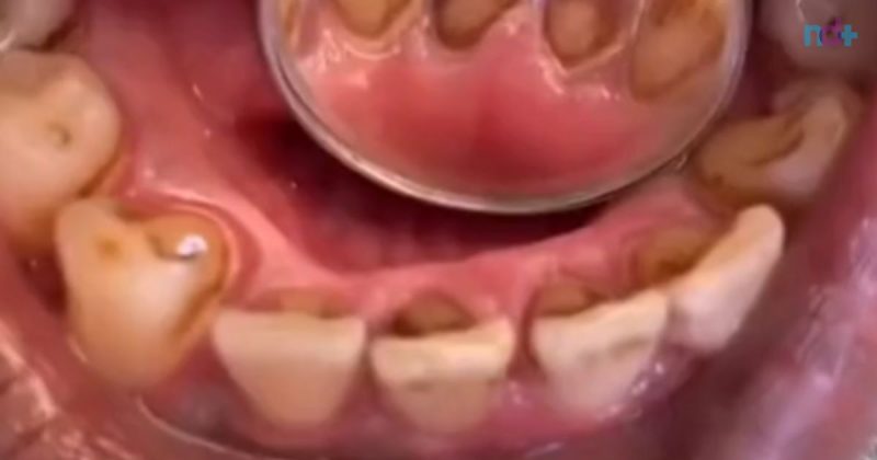 imagem mostra boca durante análise de dentista; mau hálito é uma dos problemas mais relatados entre os brasileiros