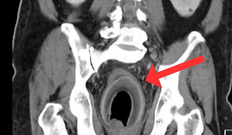 Exame de imagem mostrando coco no ânus de paciente