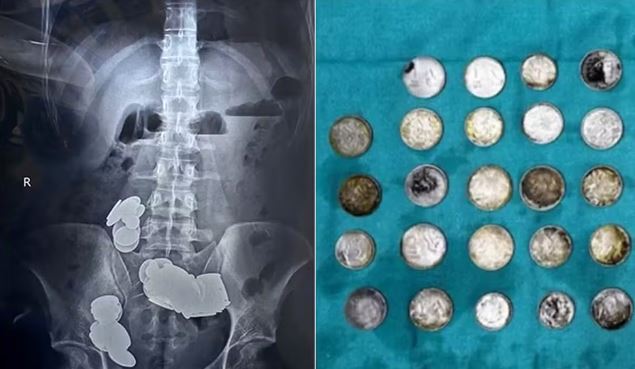 Homem engole moedas que são retiradas apenas em cirurgias 
