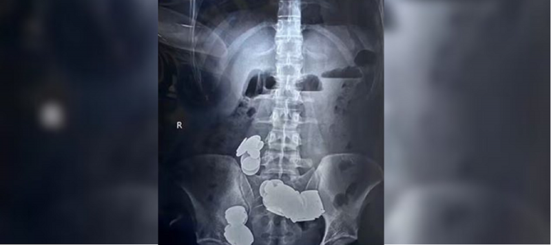 Homem engole moedas e acaba na mesa de cirurgia 