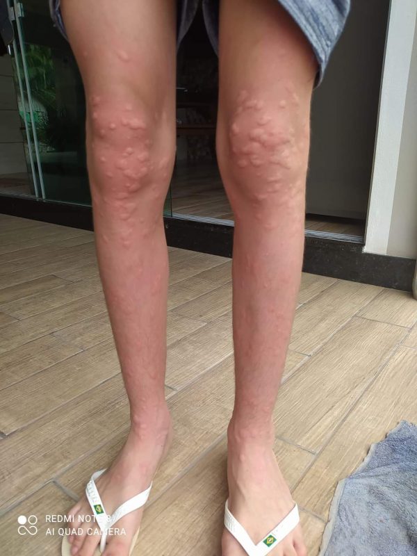 Imagem mostra perna inchada após inúmeras picadas de maruim